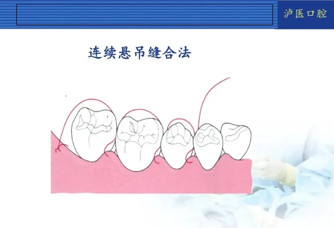 翻瓣手术如何做，看完这篇手术思路更清晰！