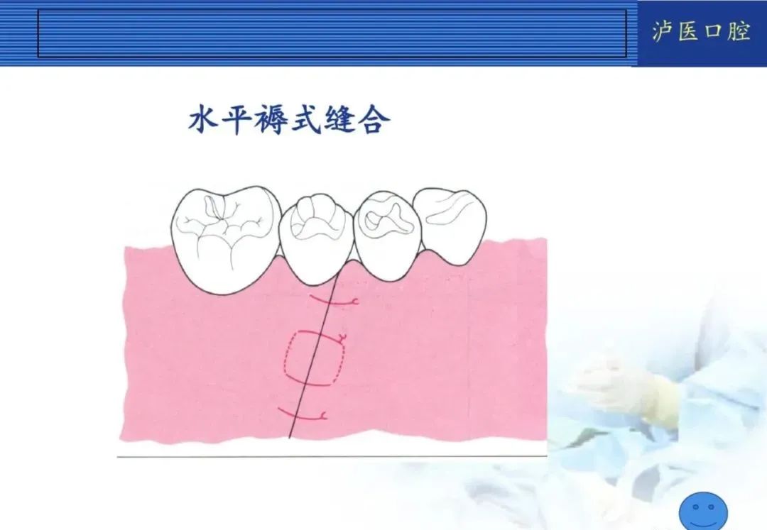 翻瓣手术如何做，看完这篇手术思路更清晰！