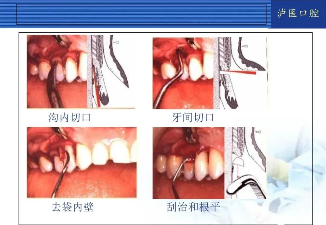 翻瓣手术如何做，看完这篇手术思路更清晰！