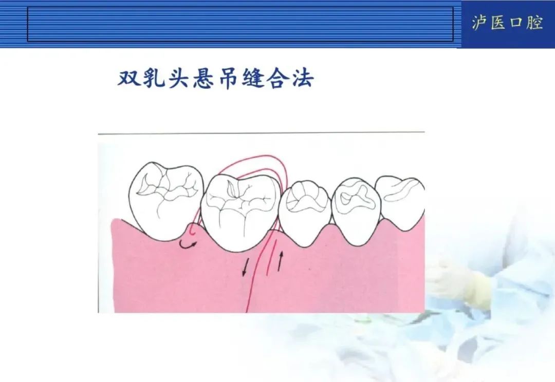 翻瓣手术如何做，看完这篇手术思路更清晰！