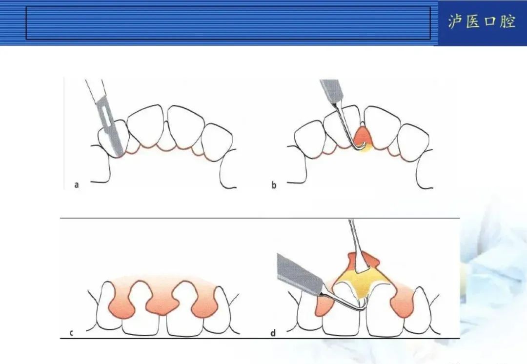 翻瓣手术如何做，看完这篇手术思路更清晰！