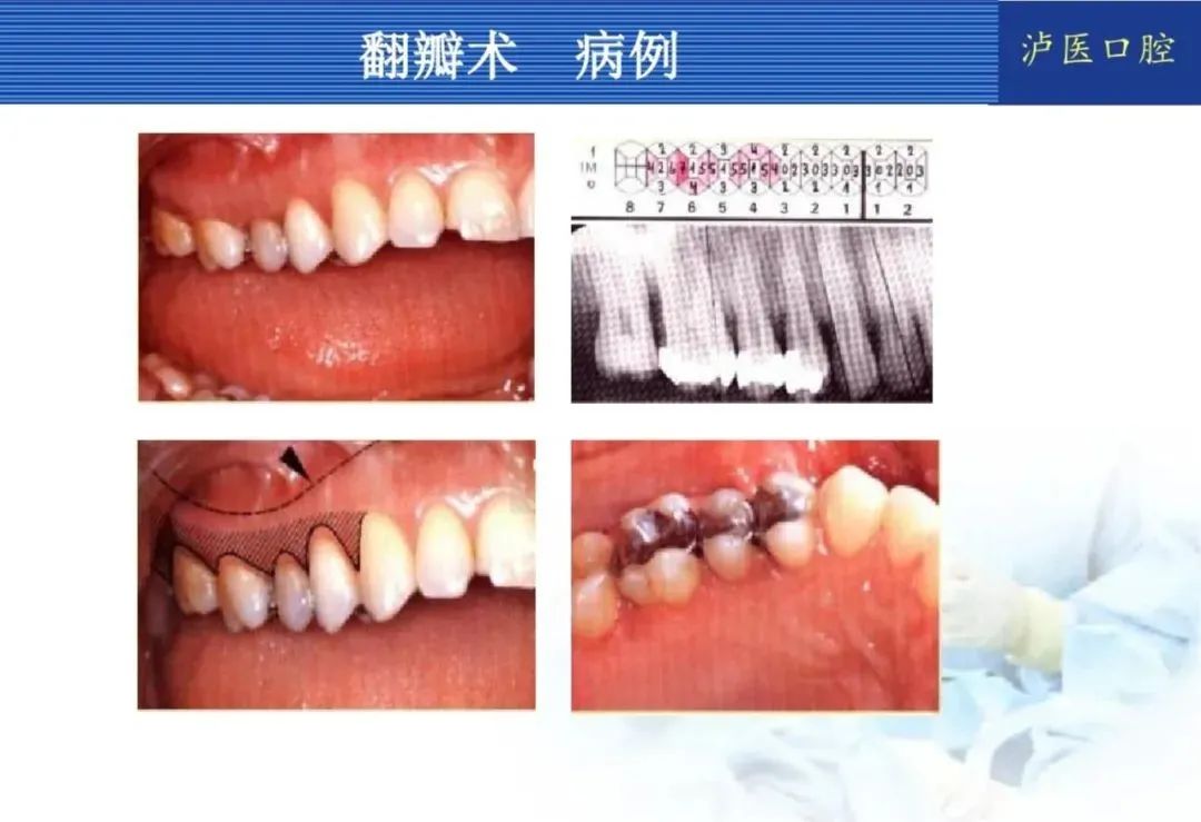 翻瓣手术如何做，看完这篇手术思路更清晰！