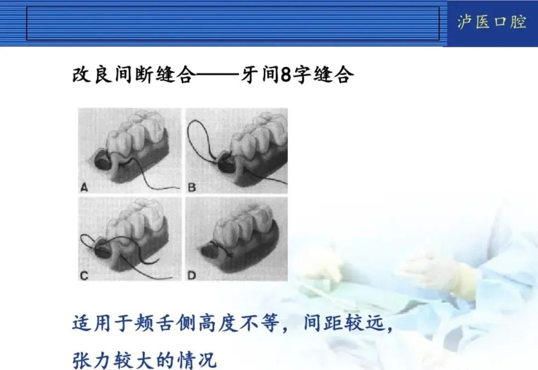 翻瓣手术如何做，看完这篇手术思路更清晰！
