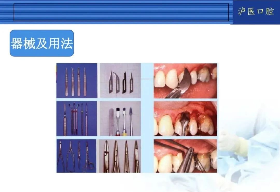翻瓣手术如何做，看完这篇手术思路更清晰！