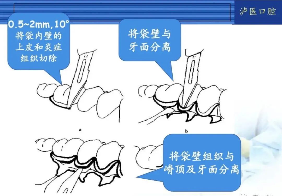 翻瓣手术如何做，看完这篇手术思路更清晰！