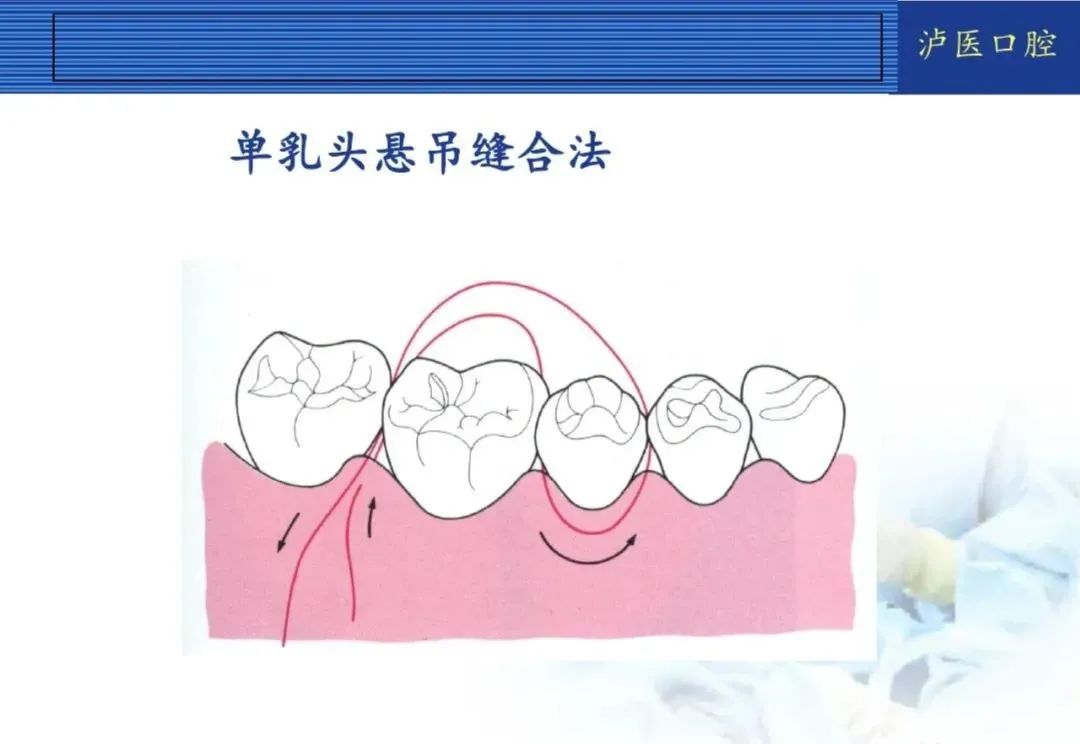 翻瓣手术如何做，看完这篇手术思路更清晰！