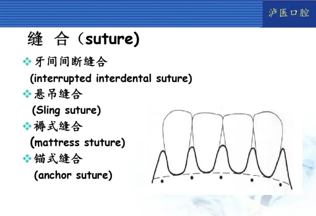 翻瓣手术如何做，看完这篇手术思路更清晰！