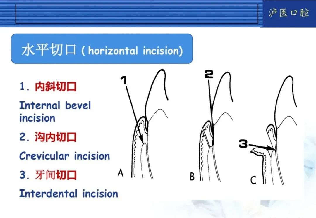 翻瓣手术如何做，看完这篇手术思路更清晰！