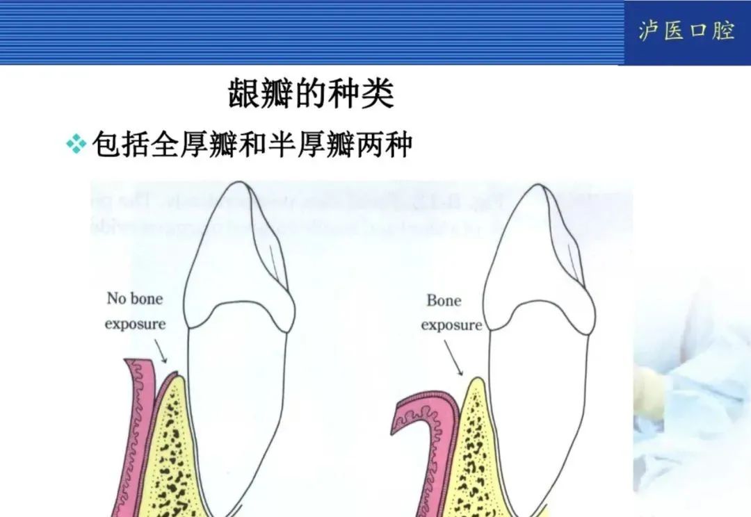 翻瓣手术如何做，看完这篇手术思路更清晰！