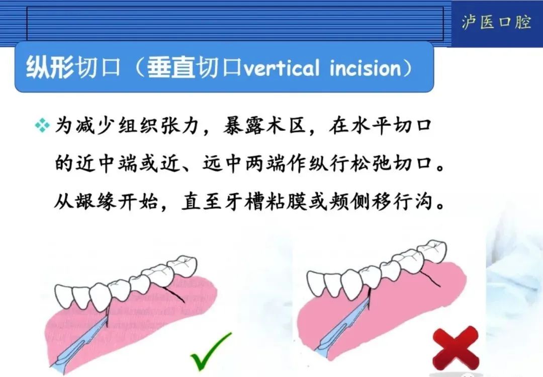 翻瓣手术如何做，看完这篇手术思路更清晰！