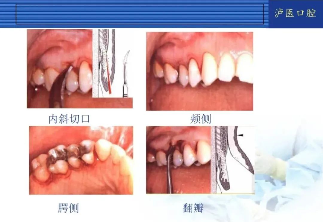 翻瓣手术如何做，看完这篇手术思路更清晰！