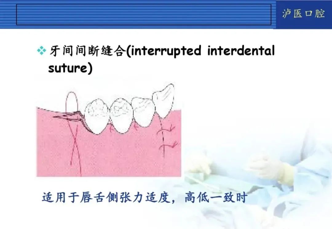 翻瓣手术如何做，看完这篇手术思路更清晰！