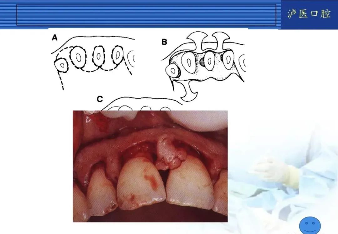 翻瓣手术如何做，看完这篇手术思路更清晰！
