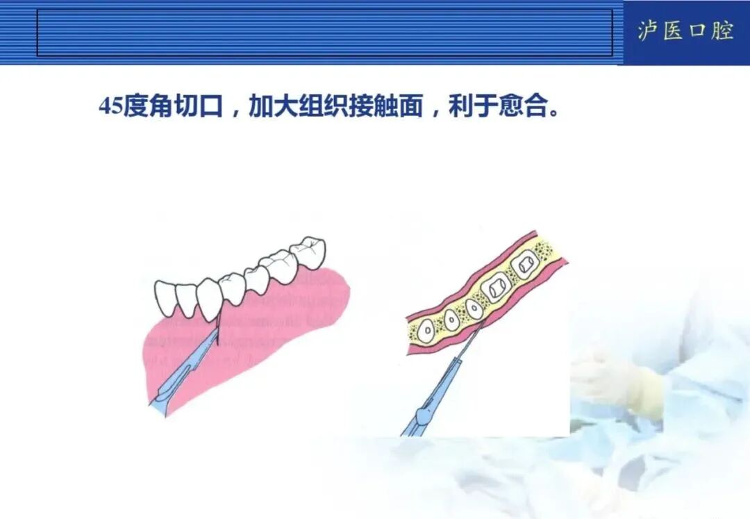 翻瓣手术如何做，看完这篇手术思路更清晰！