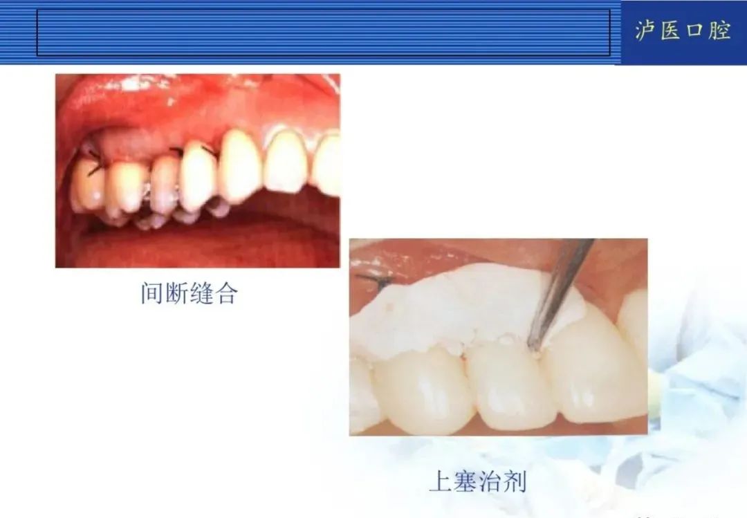 翻瓣手术如何做，看完这篇手术思路更清晰！
