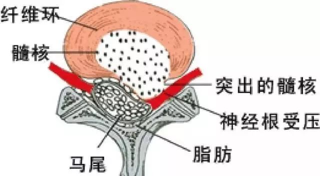 由各種原因造成纖維環破裂,髓核突出壓迫硬膜囊和神經根