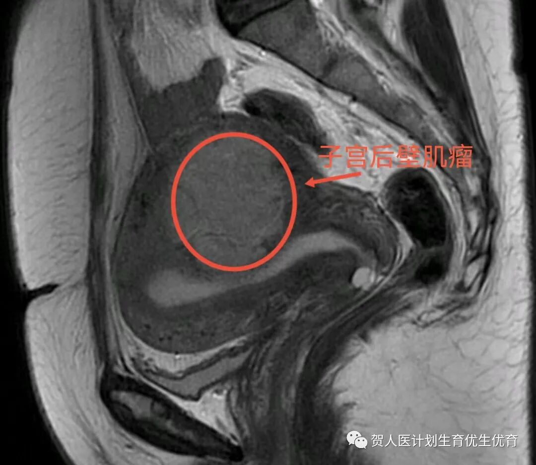 妇科微波治疗怎么做创新！微波消融术用于治疗子宫动静脉瘘_https://www.jmylbn.com_新闻资讯_第6张