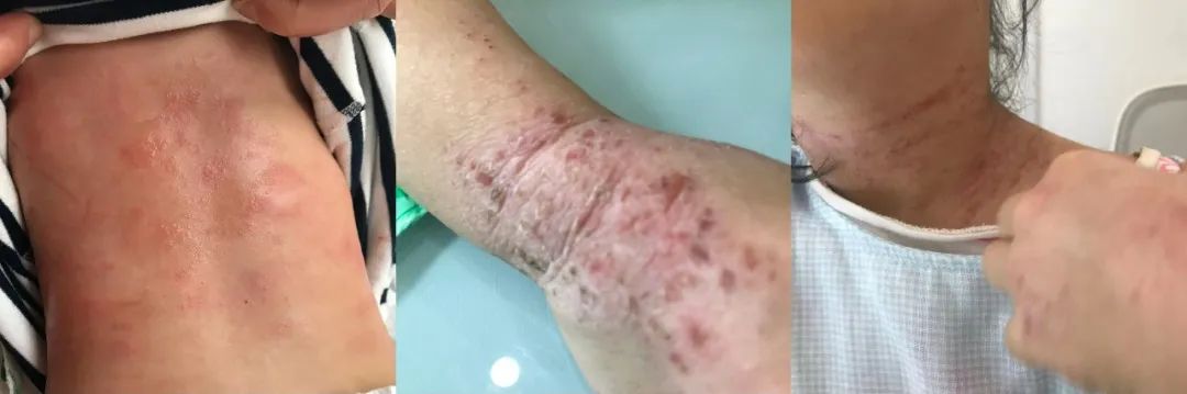 医案：滚鸡蛋治好湿疹、痱子、黑眼圈！五分钟拔除梅雨天湿毒、热毒