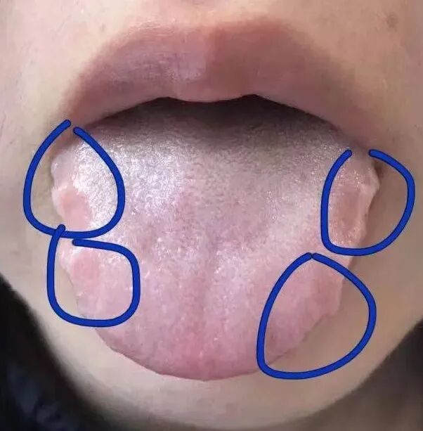 舌头的两侧边缘,出现一个一个牙齿印,就像饺子花边一样说回今天主题