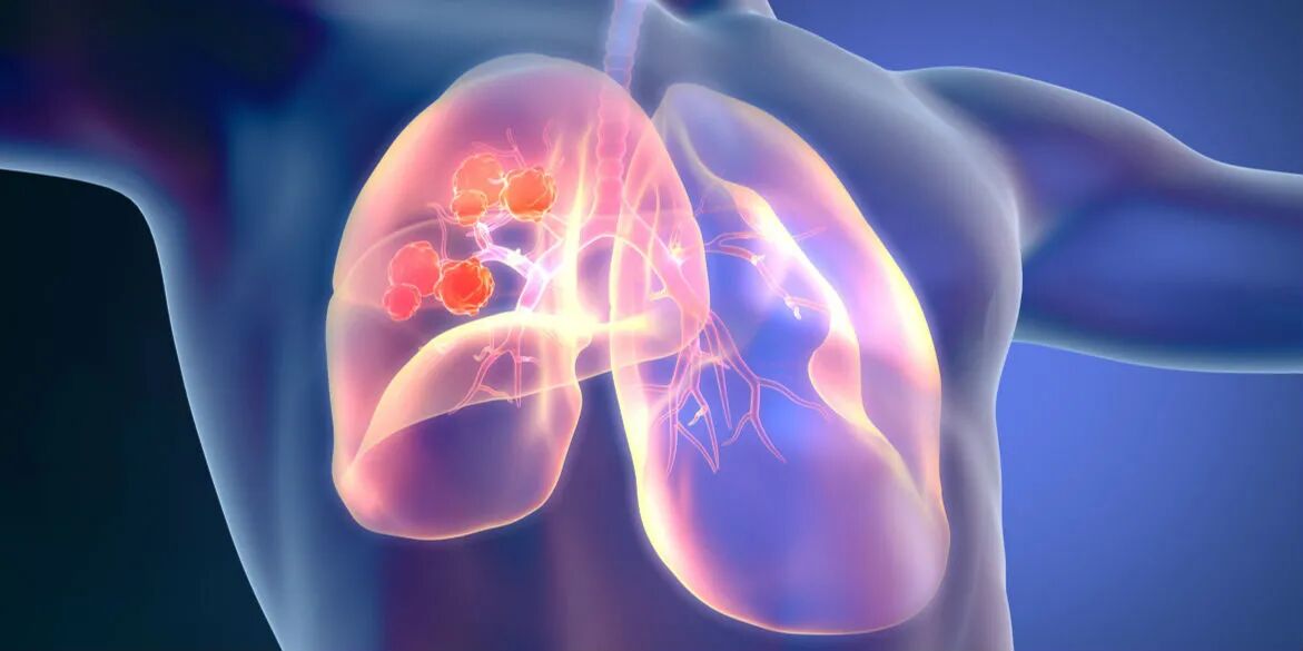 基石药业宣布洛拉替尼治疗ROS1阳性非小细胞肺癌临床试验申请已获国家药监局受理