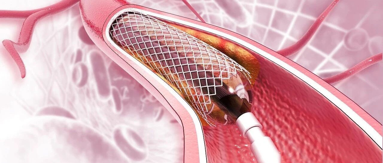 经观头条 | 心脏支架往事：成本三四百的耗材成医药回扣“重灾区” 滥用问题引90年代引进专家强烈反对