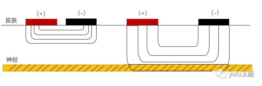 中频为什么能镇痛收藏：关于中频电疗非常客观的一篇科普文章_https://www.jmylbn.com_新闻资讯_第6张