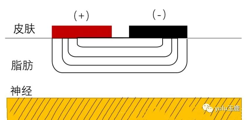 中频为什么能镇痛收藏：关于中频电疗非常客观的一篇科普文章_https://www.jmylbn.com_新闻资讯_第7张