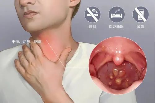 慢性咽炎的用药思路