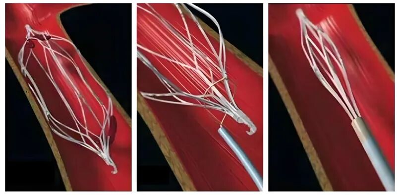 什么是介入耗材盘点介入医学中有哪些植入耗材？_https://www.jmylbn.com_新闻资讯_第5张