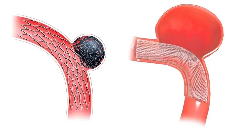 什么是介入耗材盘点介入医学中有哪些植入耗材？_https://www.jmylbn.com_新闻资讯_第9张