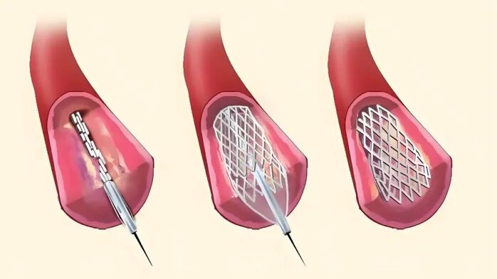 什么是介入耗材盘点介入医学中有哪些植入耗材？_https://www.jmylbn.com_新闻资讯_第4张