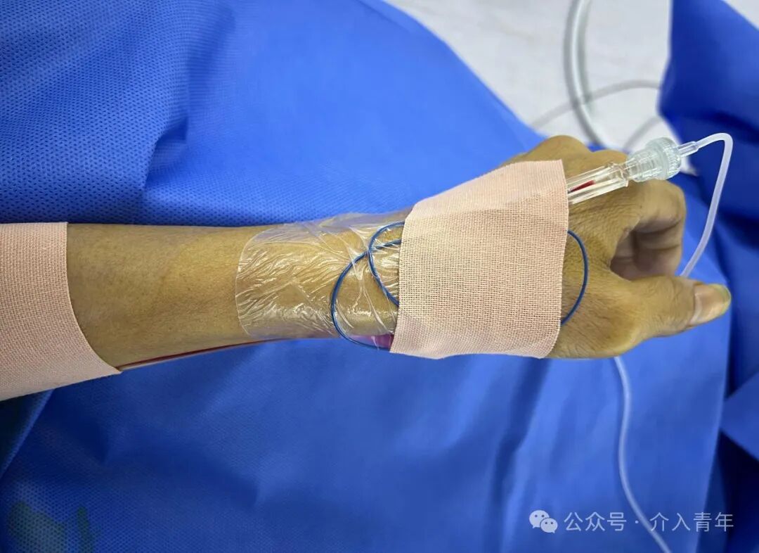 桡动脉鞘怎么读手把手教你如何做单微导管HAIC_https://www.jmylbn.com_新闻资讯_第11张