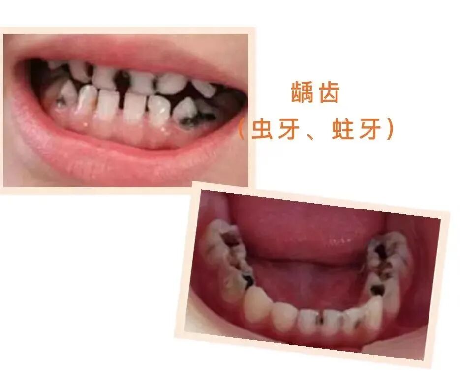 激光和电刀区别是什么为什么要剪舌系带？_https://www.jmylbn.com_新闻资讯_第19张