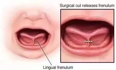 激光和电刀区别是什么为什么要剪舌系带？_https://www.jmylbn.com_新闻资讯_第25张