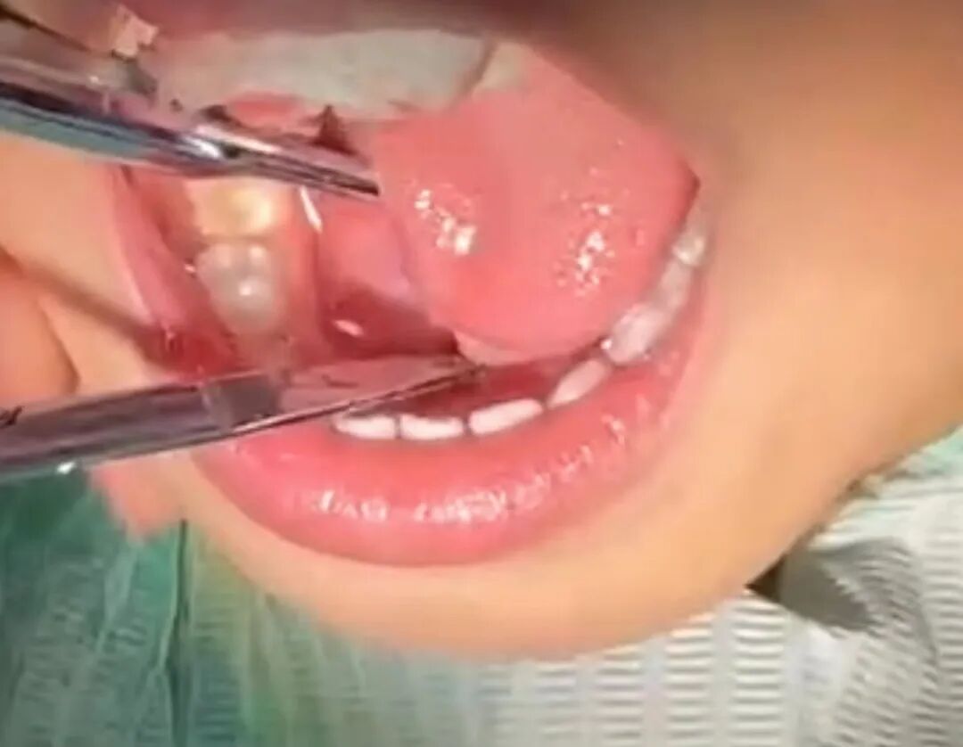 激光和电刀区别是什么为什么要剪舌系带？_https://www.jmylbn.com_新闻资讯_第27张