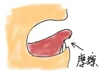 激光和电刀区别是什么为什么要剪舌系带？_https://www.jmylbn.com_新闻资讯_第17张