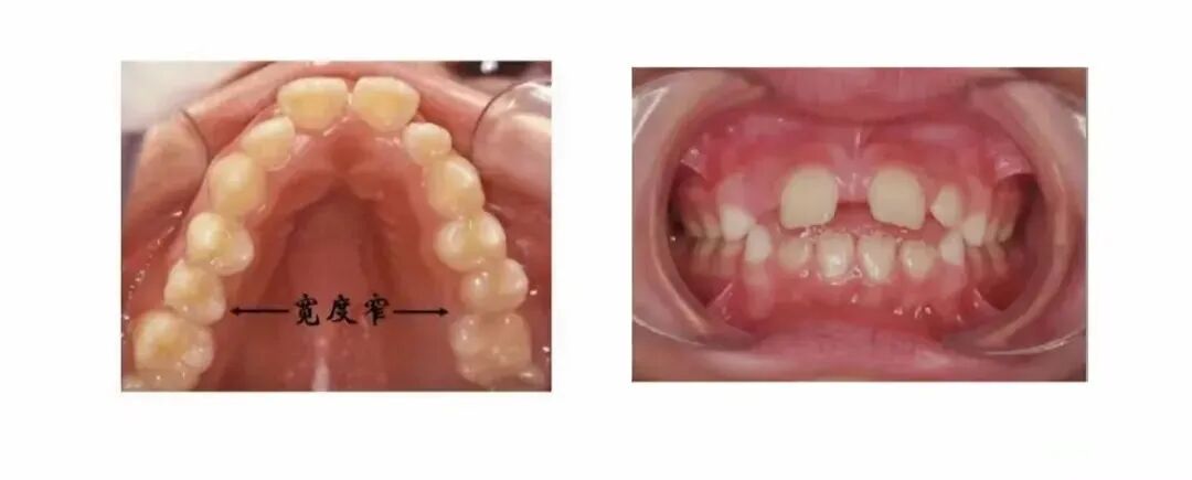 激光和电刀区别是什么为什么要剪舌系带？_https://www.jmylbn.com_新闻资讯_第20张