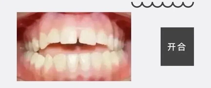 激光和电刀区别是什么为什么要剪舌系带？_https://www.jmylbn.com_新闻资讯_第22张