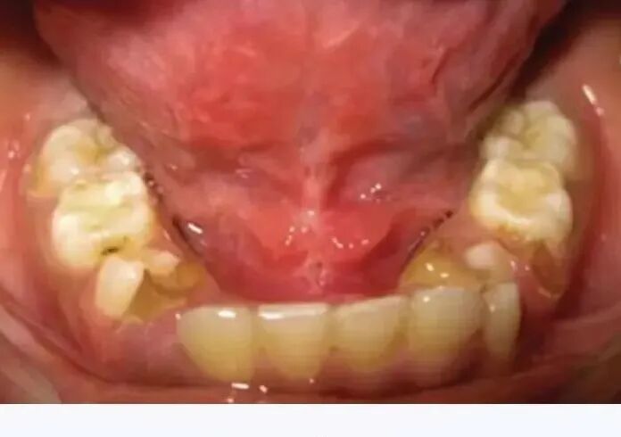 激光和电刀区别是什么为什么要剪舌系带？_https://www.jmylbn.com_新闻资讯_第30张