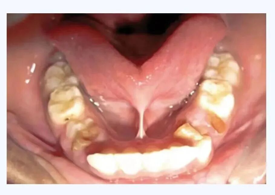 激光和电刀区别是什么为什么要剪舌系带？_https://www.jmylbn.com_新闻资讯_第29张