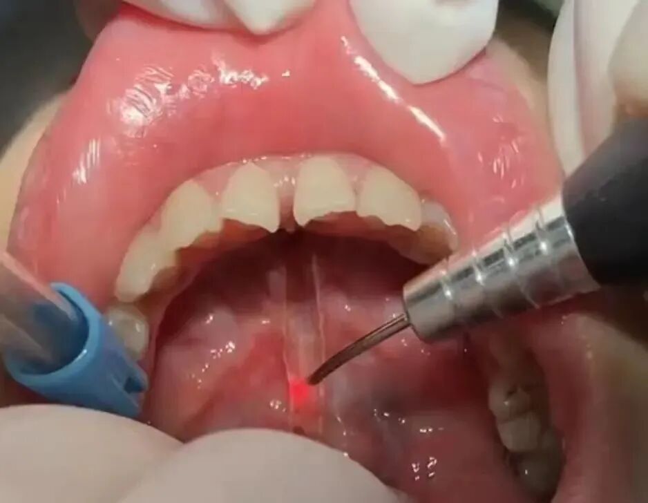 激光和电刀区别是什么为什么要剪舌系带？_https://www.jmylbn.com_新闻资讯_第28张