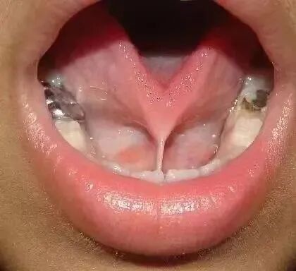 激光和电刀区别是什么为什么要剪舌系带？_https://www.jmylbn.com_新闻资讯_第10张