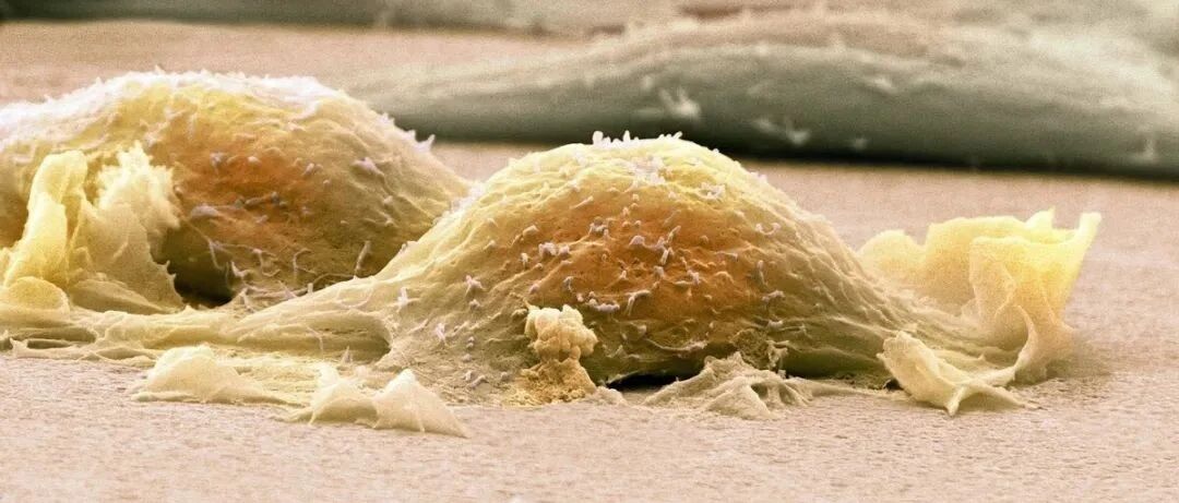 良性肿瘤和恶性肿瘤的区别是什么？癌和肉瘤又有什么区别？