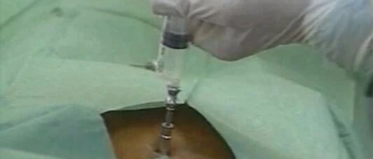 北京血液病医院史淑荣：其实，骨髓穿刺检查并没有想象中的那么可怕！