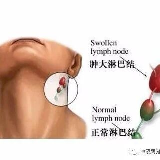 淋巴结和淋巴瘤有什么区别？