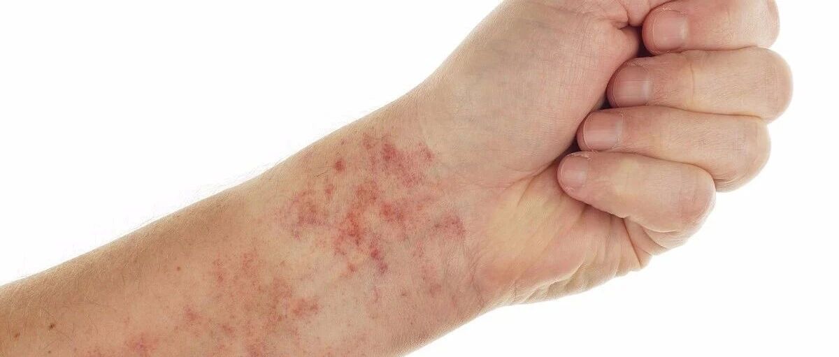 过敏性紫癜是什么？