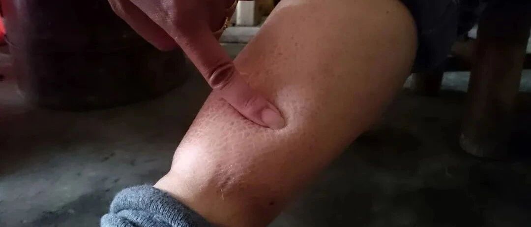 过敏性紫癜能根治吗？如何根治？