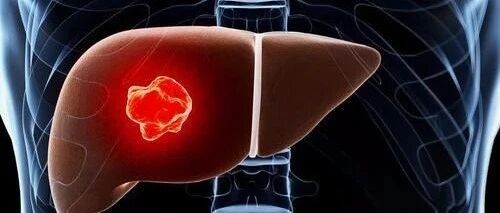 预防肝癌，这五点一定要做好！