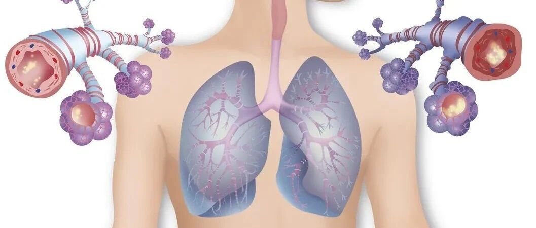 胸闷气短就一定是新冠肺炎？医生建议做检查，用这些报告消除疑虑