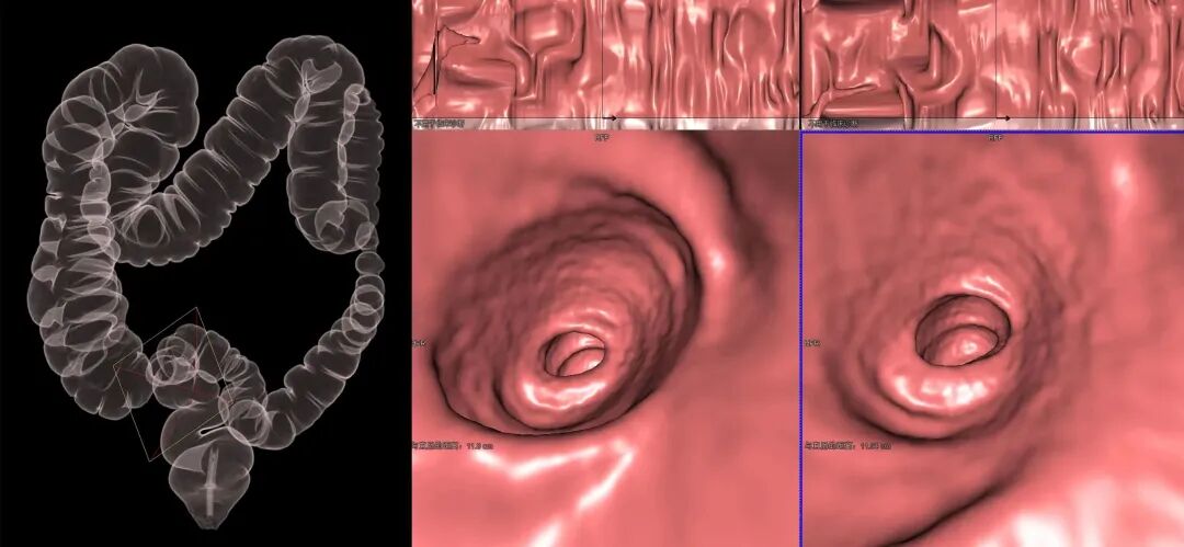 电子直肠镜怎么做CT也能做“肠镜”了！？ 不用插管！不用脱裤子_https://www.jmylbn.com_新闻资讯_第2张